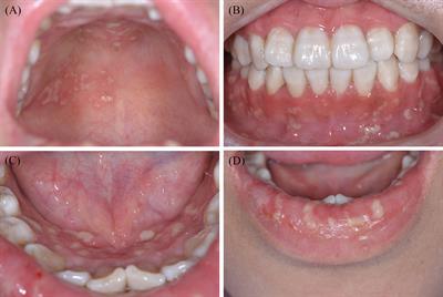 Oral manifestations serve as potential signs of ulcerative colitis: A review